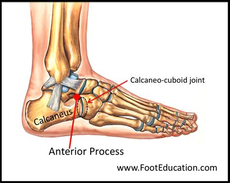 Anterior Process Fracture of the Calcaneus - FootEducation