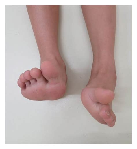 A photograph showing uncorrectable equinovarus deformity of the left... | Download Scientific ...