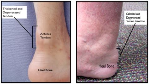 Insertional Achilles Tendonitis