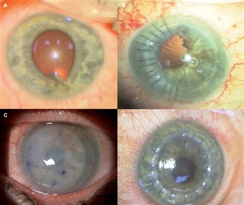 Corneal Injury - StatPearls - NCBI Bookshelf