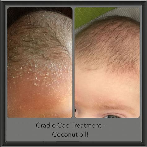 Cradle Cap Remedy - All Natural, No Chemicals - Coconut Oil!! | Cradle cap treatment, Cradle cap ...