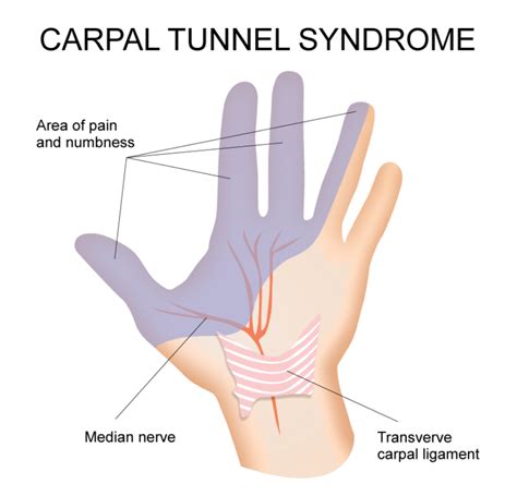 Carpal Tunnel Syndrome – Hand Therapy Group