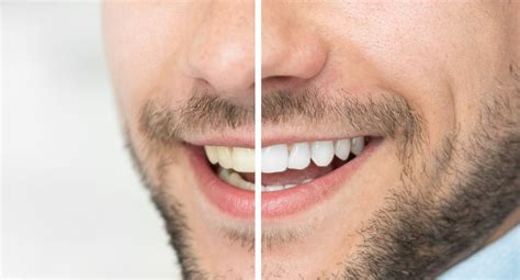 Are Whitening Treatments Bad For Your Teeth? - Dentist in Plano, TX