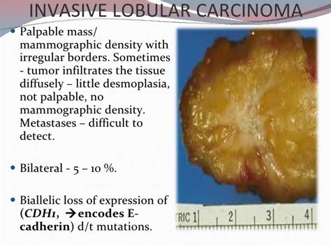 Pin op "Lobular carcinoma"