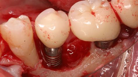 Dental implant contamination: 3 reasons behind a late-stage failure ...