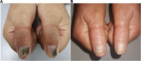 Frontiers | Case report: Novel use of the conventional method- chemical nail avulsion may be ...