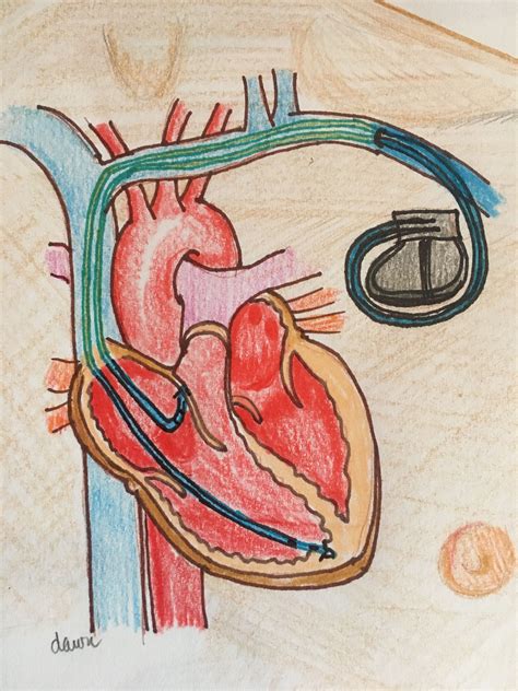 Dual Chamber Pacemaker Illlustration | ECG Guru - Instructor Resources