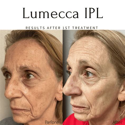 Lumecca IPL Before & After Images | EMME Medical Spa