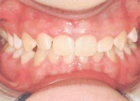 Gingivitis | Pinefield Dental