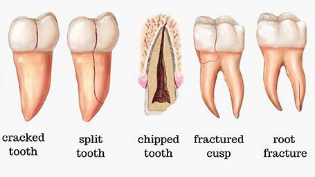 Cracked Tooth Symptoms, Treatments, and Recovery | Endodoncia Tracy | Elite Dental Care