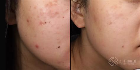 How to treat post-inflammatory hyperpigmentation PIH