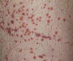 Purpuric Rashes (Causes, Symptoms and Treatment) (2023)