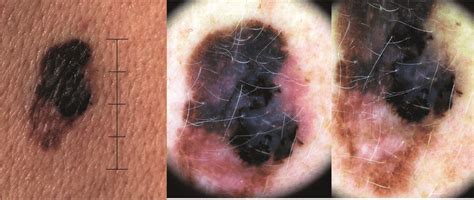 Pictures described from left to right: Melanoma (invasive, tumor... | Download Scientific Diagram