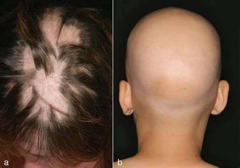 Alopecia Universalis: Causes, Stages & Treatment Options