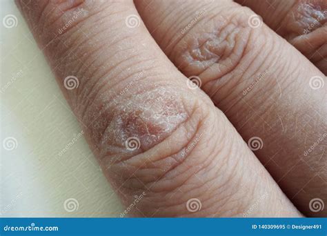 Cracked Skin Royalty-Free Stock Image | CartoonDealer.com #18902914