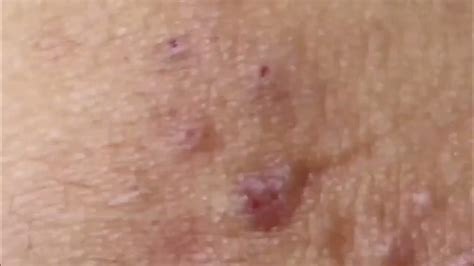 acne Blackheads Whiteheads Removal | Blackhead extraction | enilsa brown #blackheads - YouTube