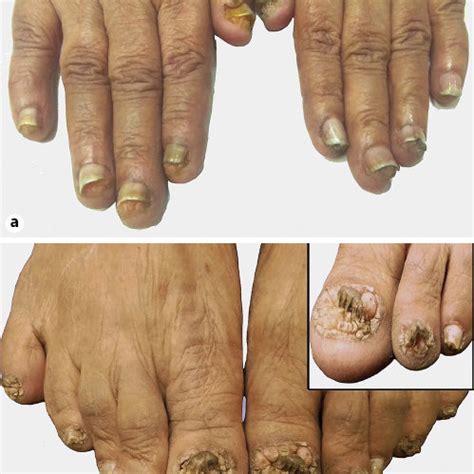 Residual periungual fibroma on the right thumb after 1% topical ...