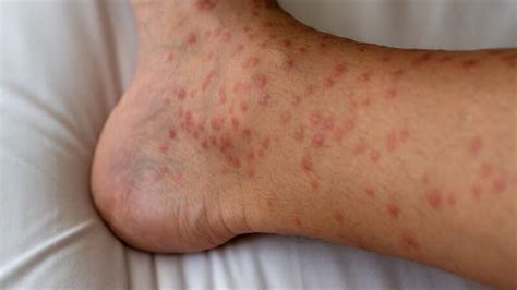 Red Spots on Skin - Causes and Treatment