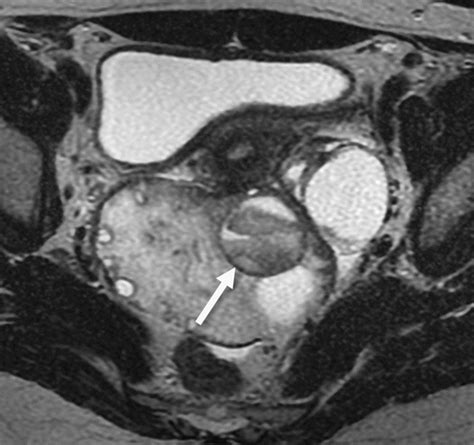 Adnexal Torsion: Review of Radiologic Appearances | RadioGraphics