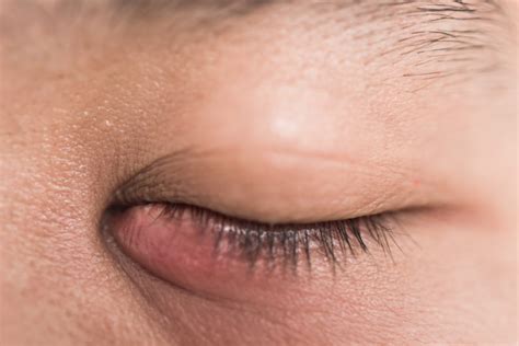 Blocked Tear Duct In Adults Causes Symptoms And Treatment – Newerarealty