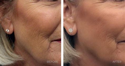 Neck Lift Alternatives: Surgical & Non-surgical Options | Omaha Cosmetic Center