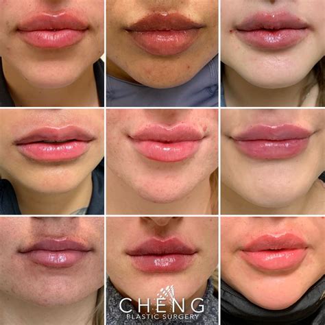 Lip Fillers Before And After Cupid's Bow | Before And After