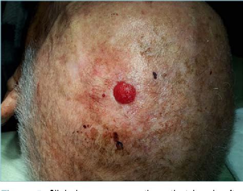 [PDF] Atypical fibroxanthoma/pleomorphic dermal sarcoma of the scalp ...