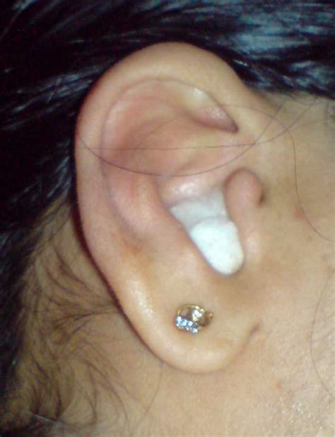 Fungal Infection Treatment In Ear at John Vanness blog