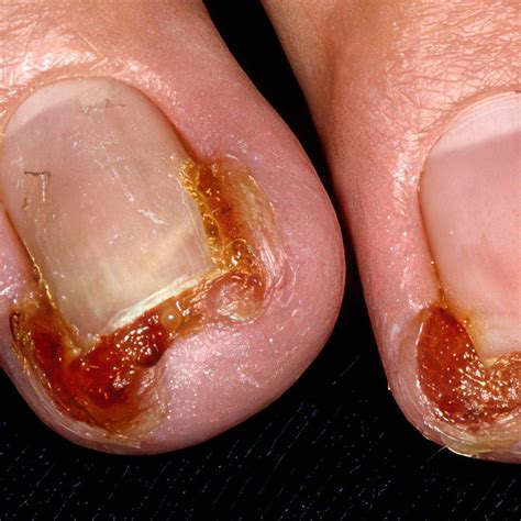 Infected Hangnail: Causes, What to Do, and When to Seek Help