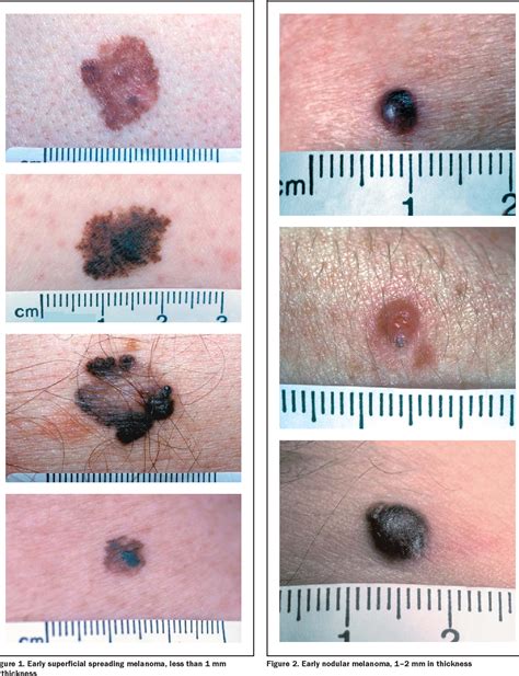 Figure 1 from Nodular melanoma. No longer as simple as ABC. | Semantic ...