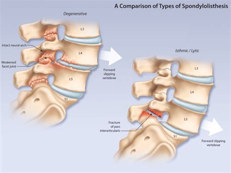 Spondylolisthesis: All You Need to Know | Dr. Hepler