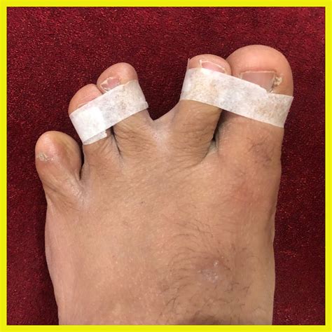 An innovative technique for the separation of toes to prevent and treat ...