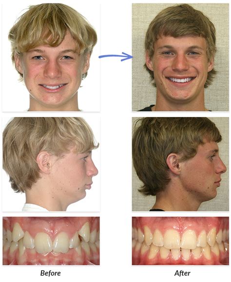 Before & After Braces Photos | DeLurgio Orthodontics : DeLurgio Orthodontics