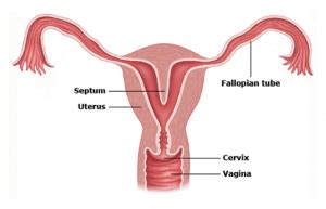 Uterine Septum Removal Found to Improve Fertility and Pregnancy Outcome - Austin Fertility ...