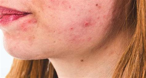 Accutane Side Effects: What Are They?