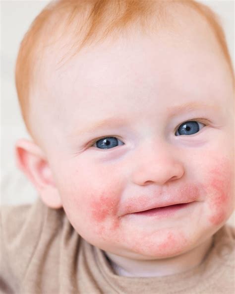 Managing Eczema Flare-ups: Effective Treatment Strategies