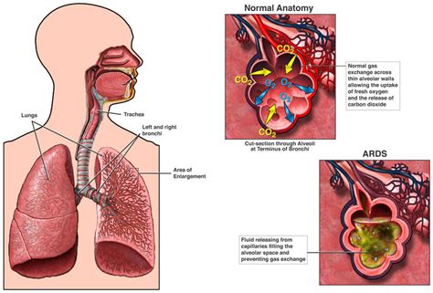 Acute Respiratory Distress Syndrome | NHLBI, NIH