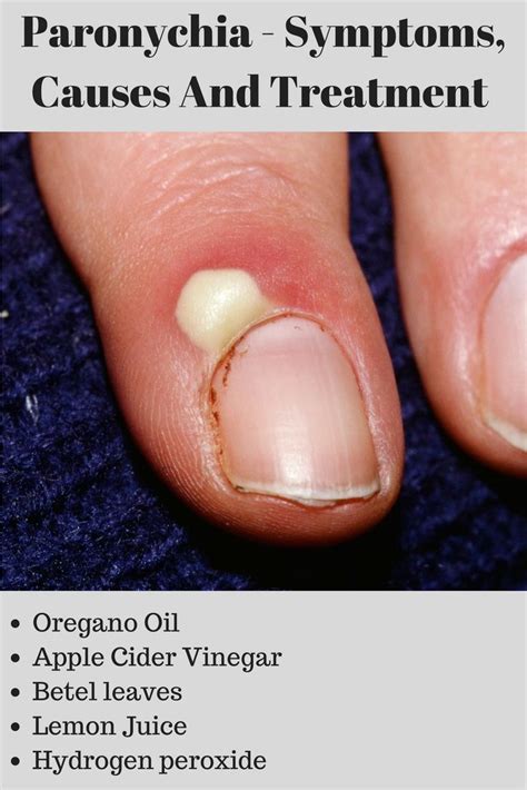 Pin by Karen on Health | Hangnail treatment, Infected toenail, Finger infection