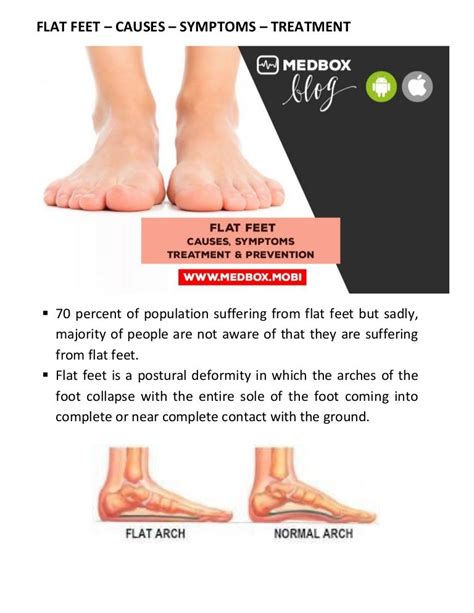 Flat feet – causes – symptoms – treatment