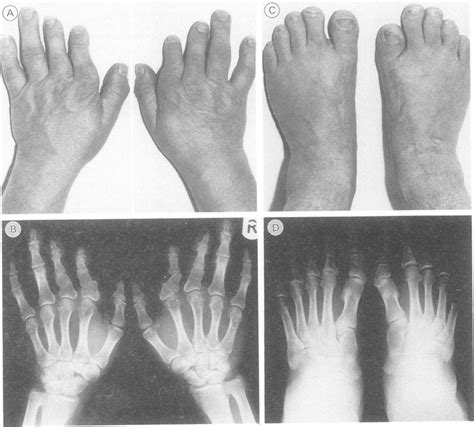 Pedigree offamily with brachydactyly type C. Subject B is the index ...