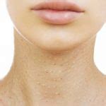 Skin Discoloration on Neck and Chest Area - What You Must Know