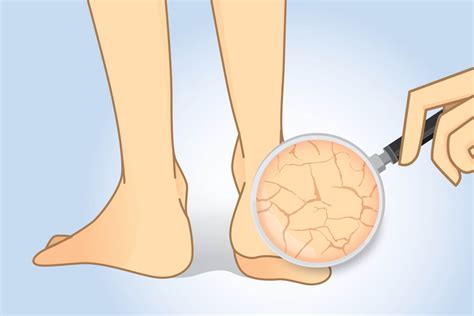 Skin Cracks & Fissures in Feet - Consulting Footpain