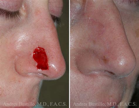 Reconstructive Surgery photos | Miami, FL. | Patient 15845