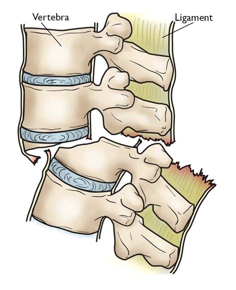 Fractures of the Thoracic and Lumbar Spine - OrthoInfo - AAOS