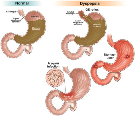 Dispepsia - AGA GI Patient Center