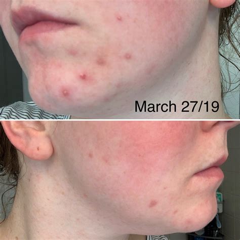 Spironolactone Progress Pics : acne