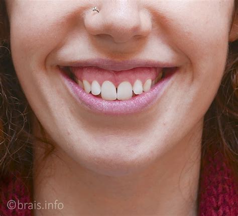 Yo tenía sonrisa gingival, hasta que al fin encontré la solución