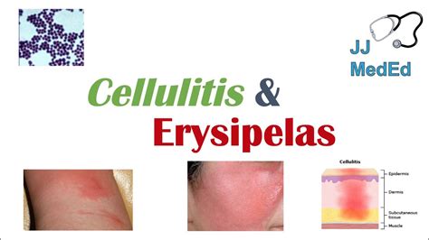 Cellulitis vs Erysipelas | Bacterial Causes, Risk Factors, Signs and Symptoms, Treatment - YouTube