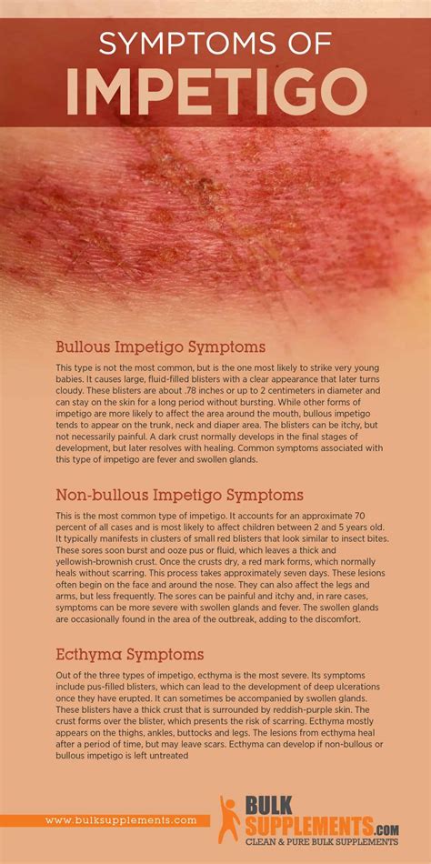 Impetigo: Symptoms, Causes & Treatment by James Denlinger