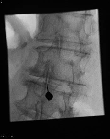 Lumbar spine (oblique view) | Radiology Reference Article | Radiopaedia.org
